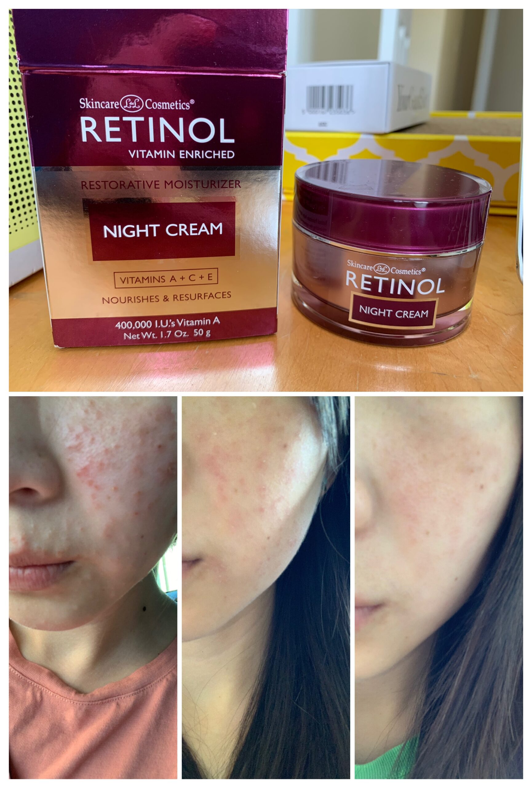 Retinol Burn経験談 Chemist Learn To Live